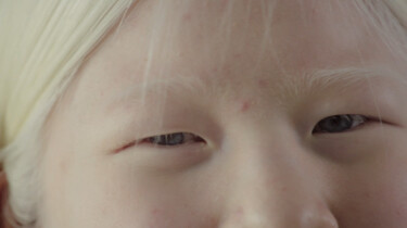 Wat is albinisme?: Weinig of geen pigment in je haar, huid en ogen