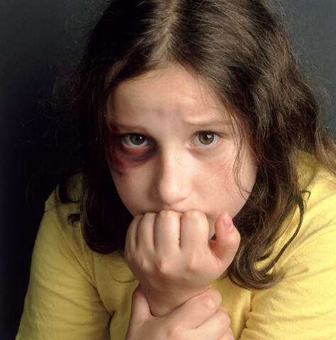 Kindermishandeling: meisje met blauw oog