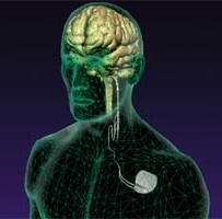 Nervus vagus-stimulatie Nervus vagus-stimulatie