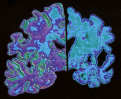 Teaserplaatje Teleac: Alzheimer brein