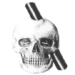Schedel van Phineas Gage